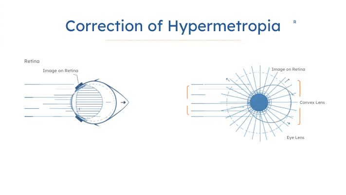 correction of myopia ray diagram class 10